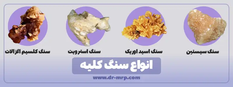 انواع سنگ کلیه