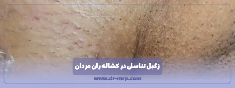 زگیل تناسلی در کشاله ران مردان