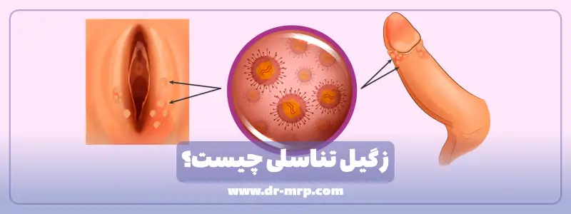 زگیل تناسلی چیست