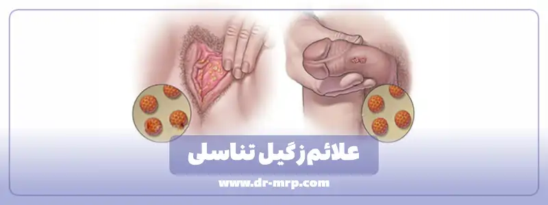 علائم زگیل تناسلی