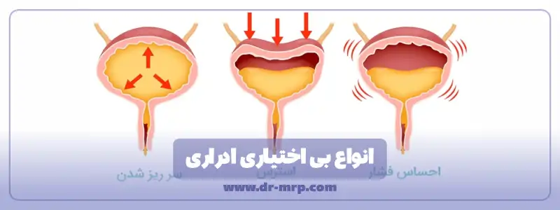 انواع بی اختیاری ادراری
