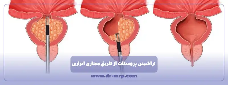 تراشیدن پروستات از طریق مجاری ادراری