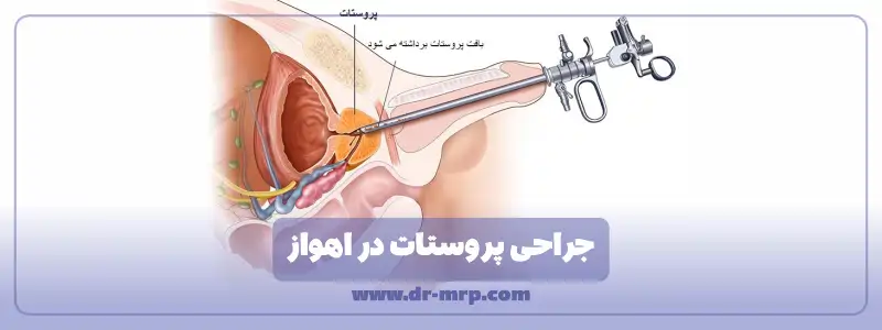 عمل TURP در اهواز