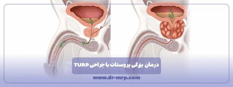 درمان بزرگی پروستات با جراحی TURP