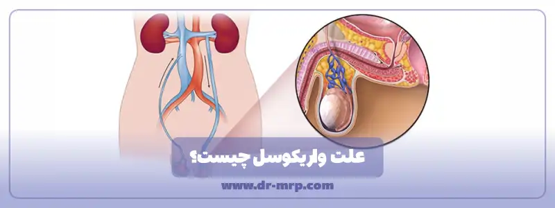 علت واریکوسل چیست
