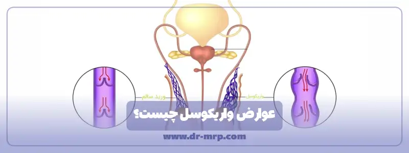 عوارض واریکوسل چیست