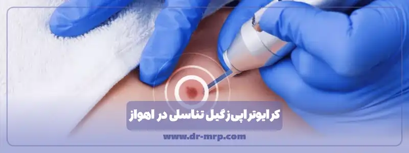 کرایوتراپی زگیل تناسلی در اهواز