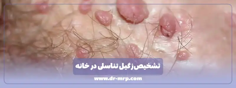 تشخیص زگیل تناسلی در خانه