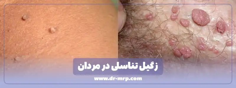 زگیل تناسلی در مردان