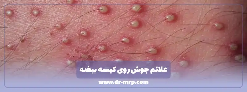 علائم جوش روی کیسه بیضه