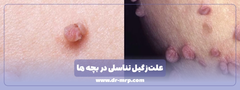 علت زگیل تناسلی در بچه ها