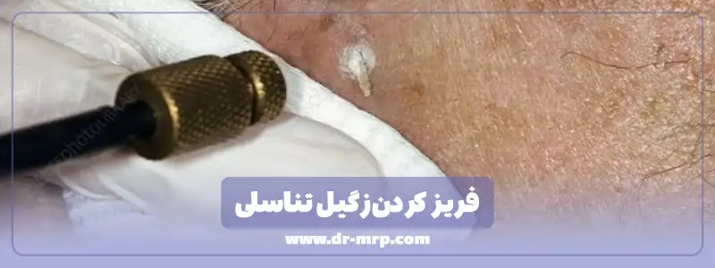 فریز کردن زگیل تناسلی