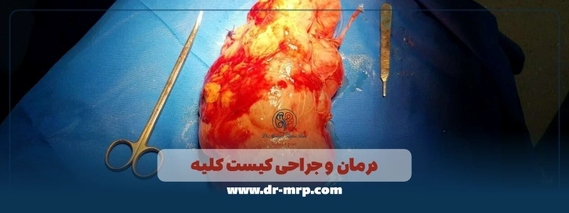 درمان و جراحی کیست کلیه