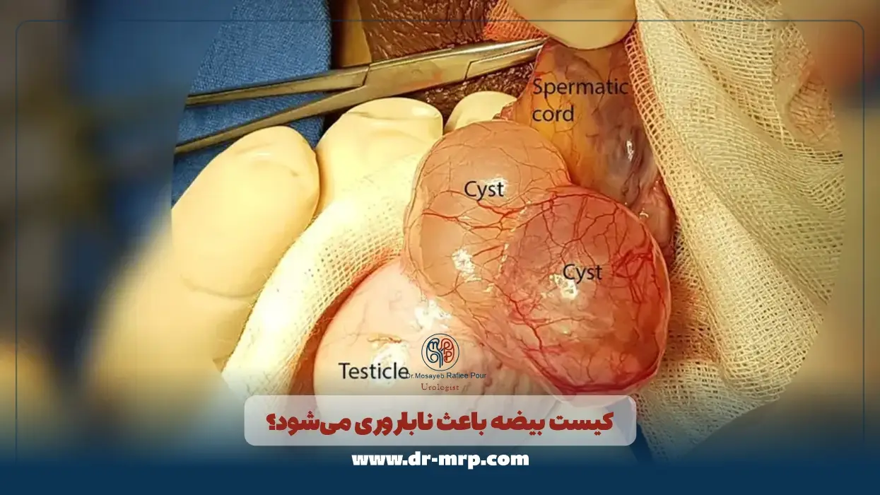 کیست بیضه باعث ناباروری میشود؟