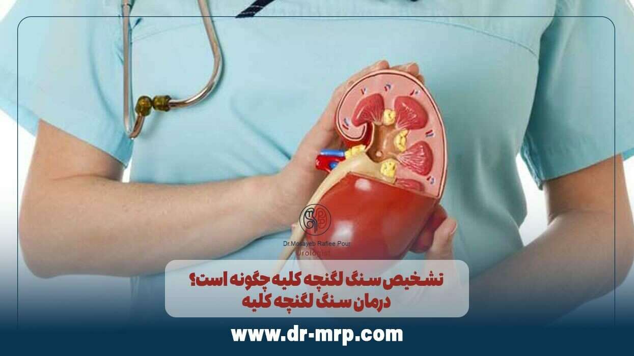 تشخیص سنگ لگنچه کلیه چگونه است؟