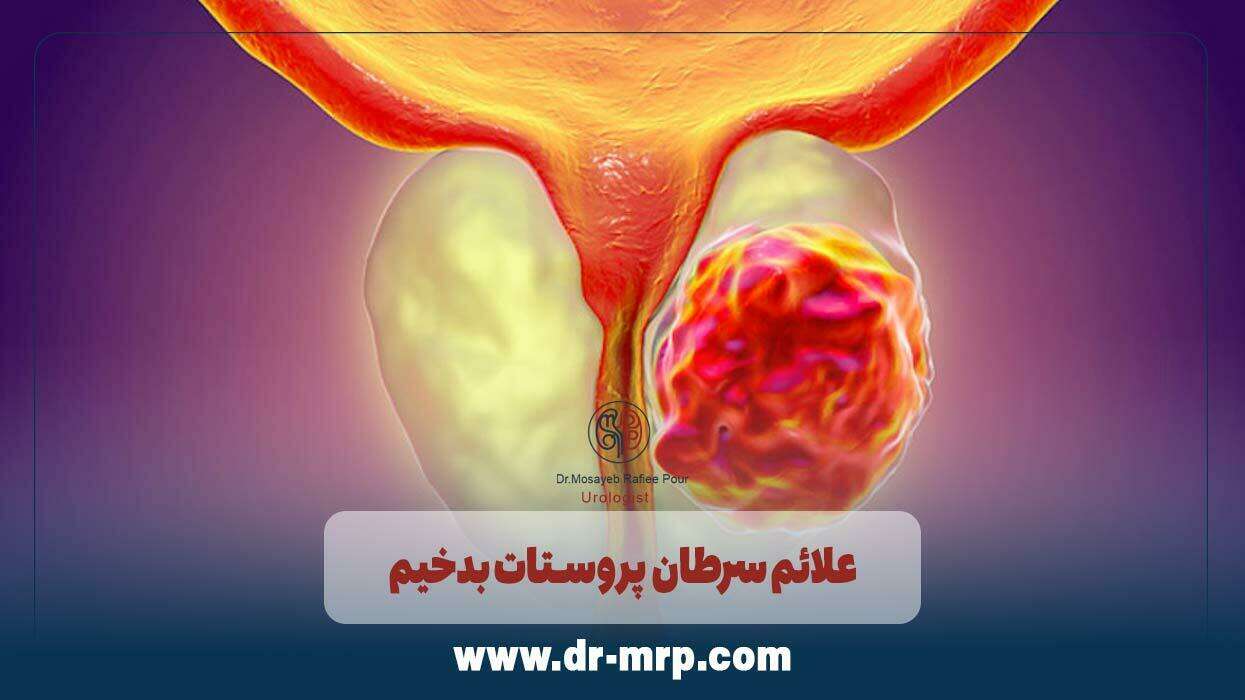 علائم سرطان پروستات بدخیم
