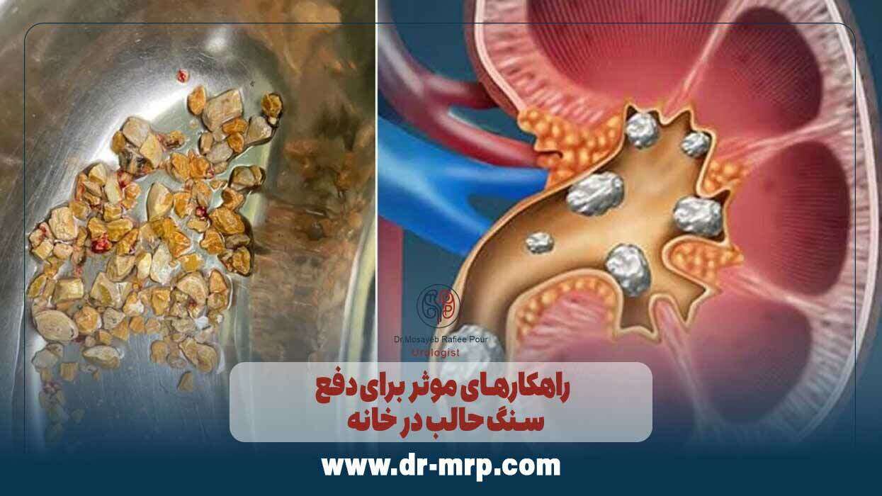 راهکارهای موثر برای دفع سنگ حالب در خانه