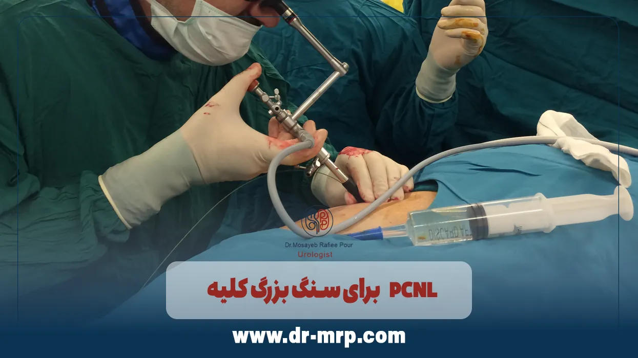 PCNL برای سنگ بزرگ کلیه