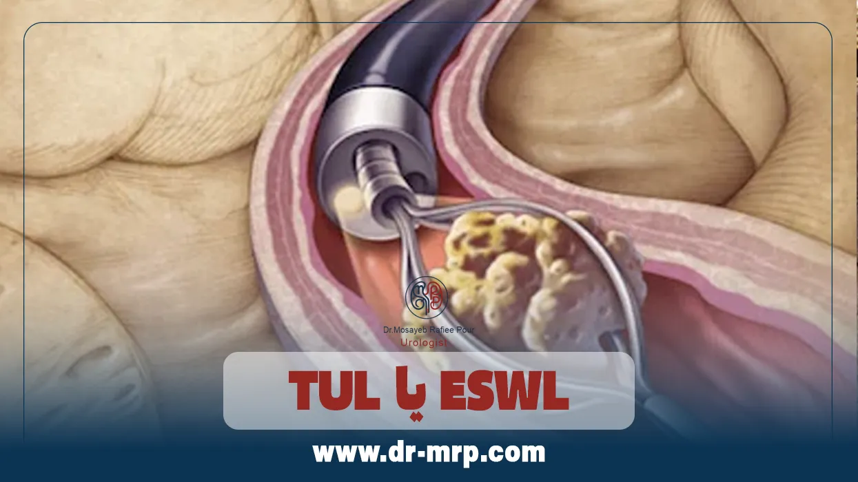 TUL یا ESWL؛ کدام روش برای چه سنگی مناسبتر است؟