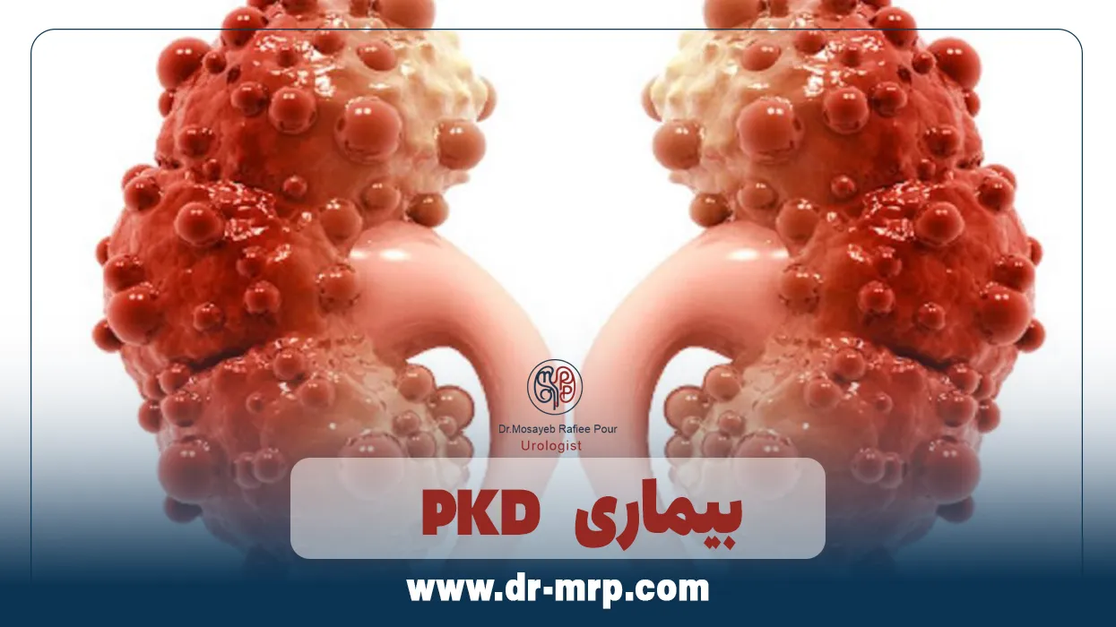 سبک زندگی مناسب در بیماران مبتلا به بیماری PKD