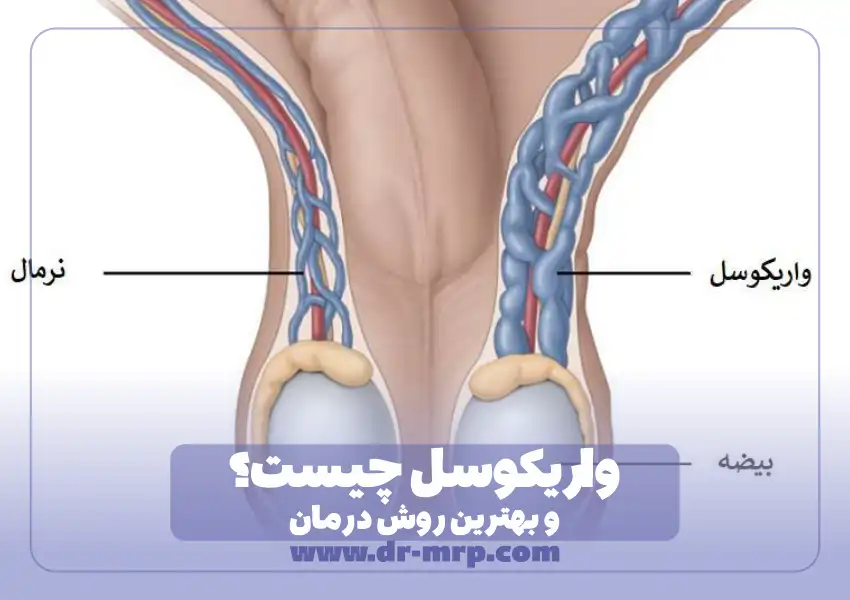واریکوسل چیست؟ و عمل واریکوسل در اهواز