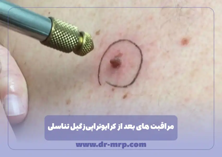 مراقبت های بعد از کرایوتراپی زگیل تناسلی