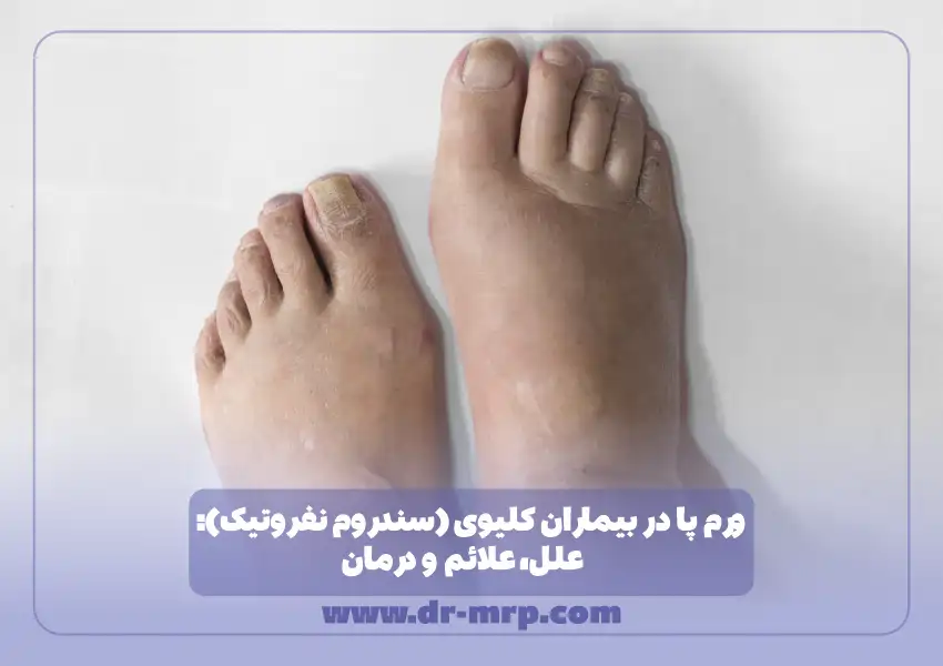 ورم پا در بیماران کلیوی (سندروم نفروتیک): علل، علائم و درمان