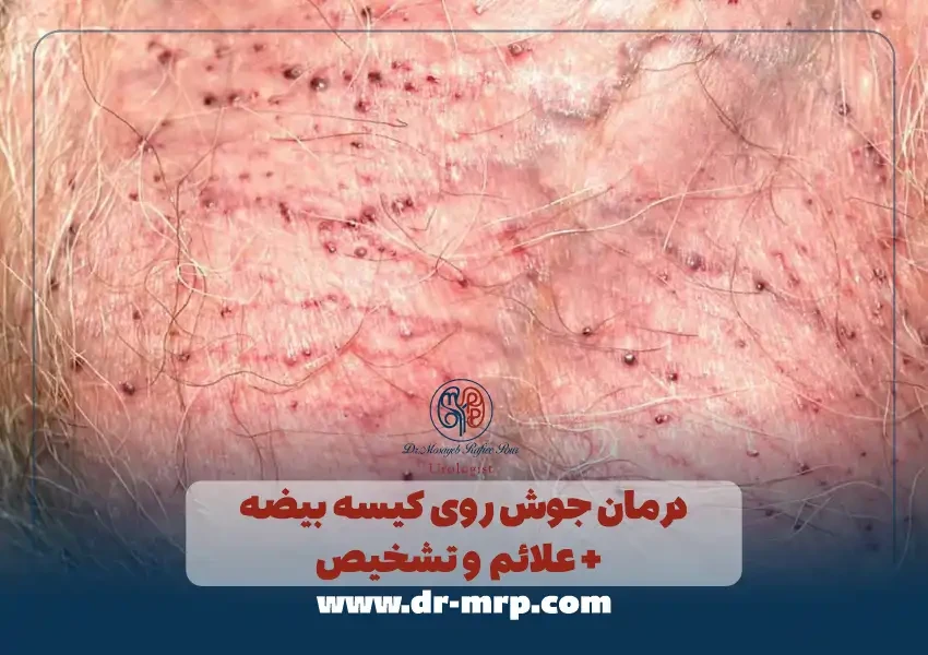 درمان جوش روی کیسه بیضه + علائم و تشخیص