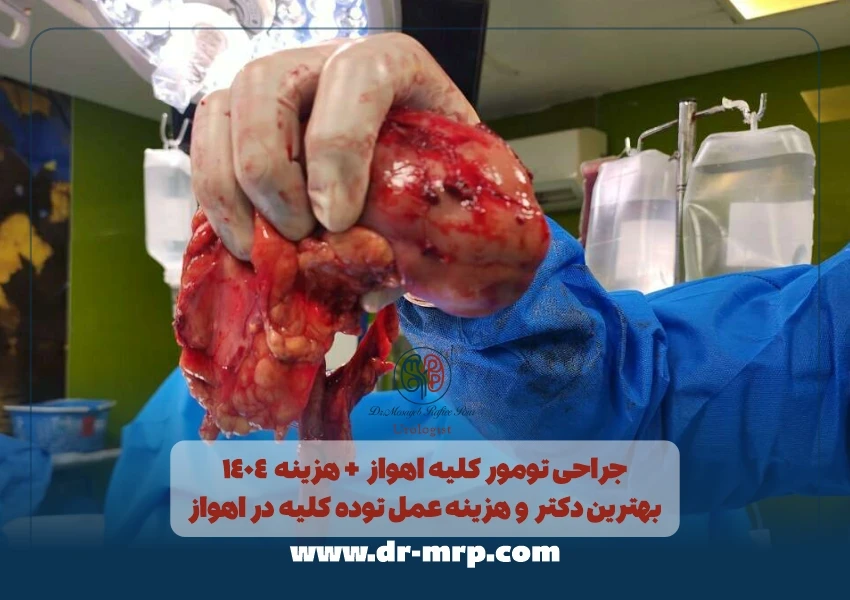 جراحی تومور کلیه اهواز + هزینه 1404 | بهترین دکتر و هزینه عمل توده کلیه در اهواز
