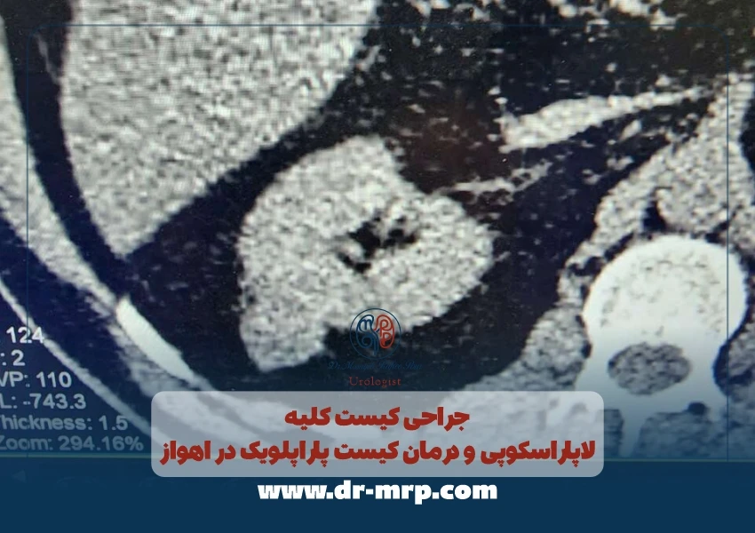 جراحی کیست کلیه | لاپاراسکوپی و درمان کیست پاراپلویک در اهواز