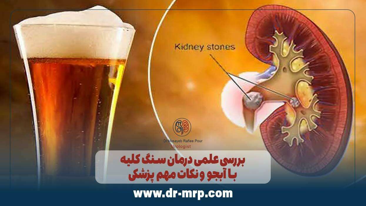 بررسی علمی درمان سنگ کلیه با آبجو و نکات مهم پزشکی