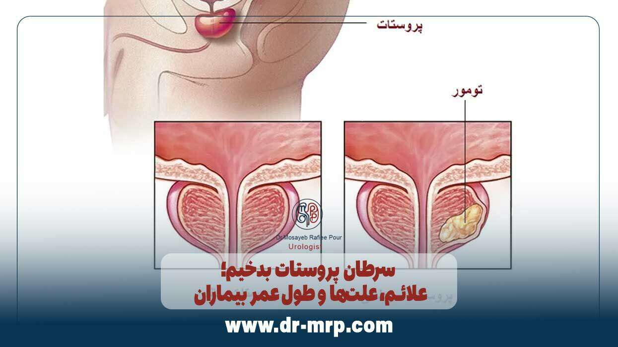 سرطان پروستات بدخیم؛ علائم، علتها و طول عمر بیماران