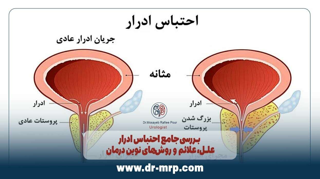 بررسی جامع احتباس ادرار: علل، علائم و روشهای نوین درمان