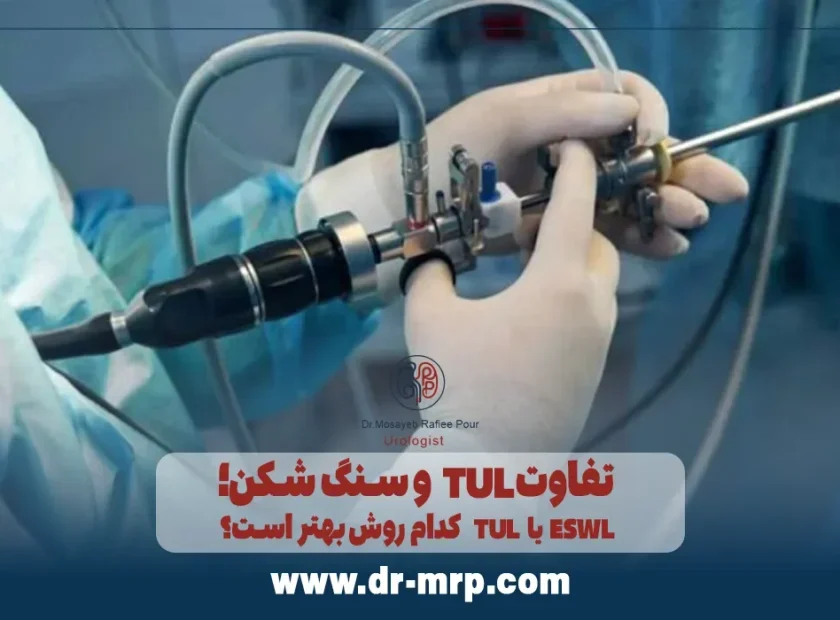 تفاوت TUL و سنگ شکن؛ TUL یا ESWL کدام روش بهتر است؟ 840x620