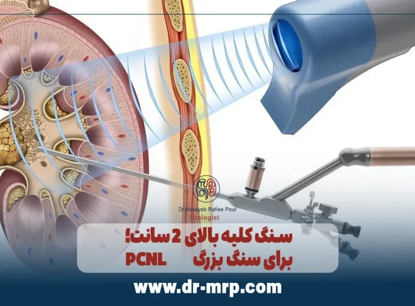 سنگ کلیه بالای 2 سانت؛ PCNL برای سنگ بزرگ 840x620